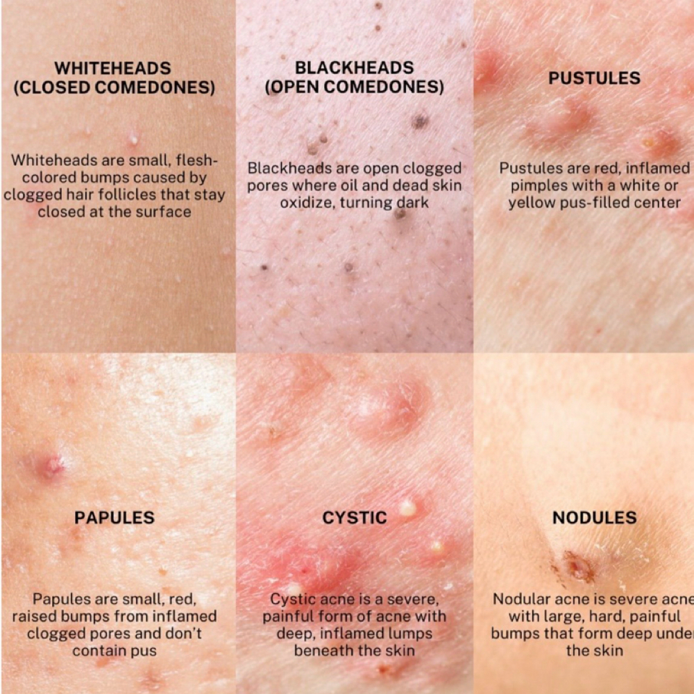 Acne Facial at Angela’s Medical Aesthetics in Rockwall, TX