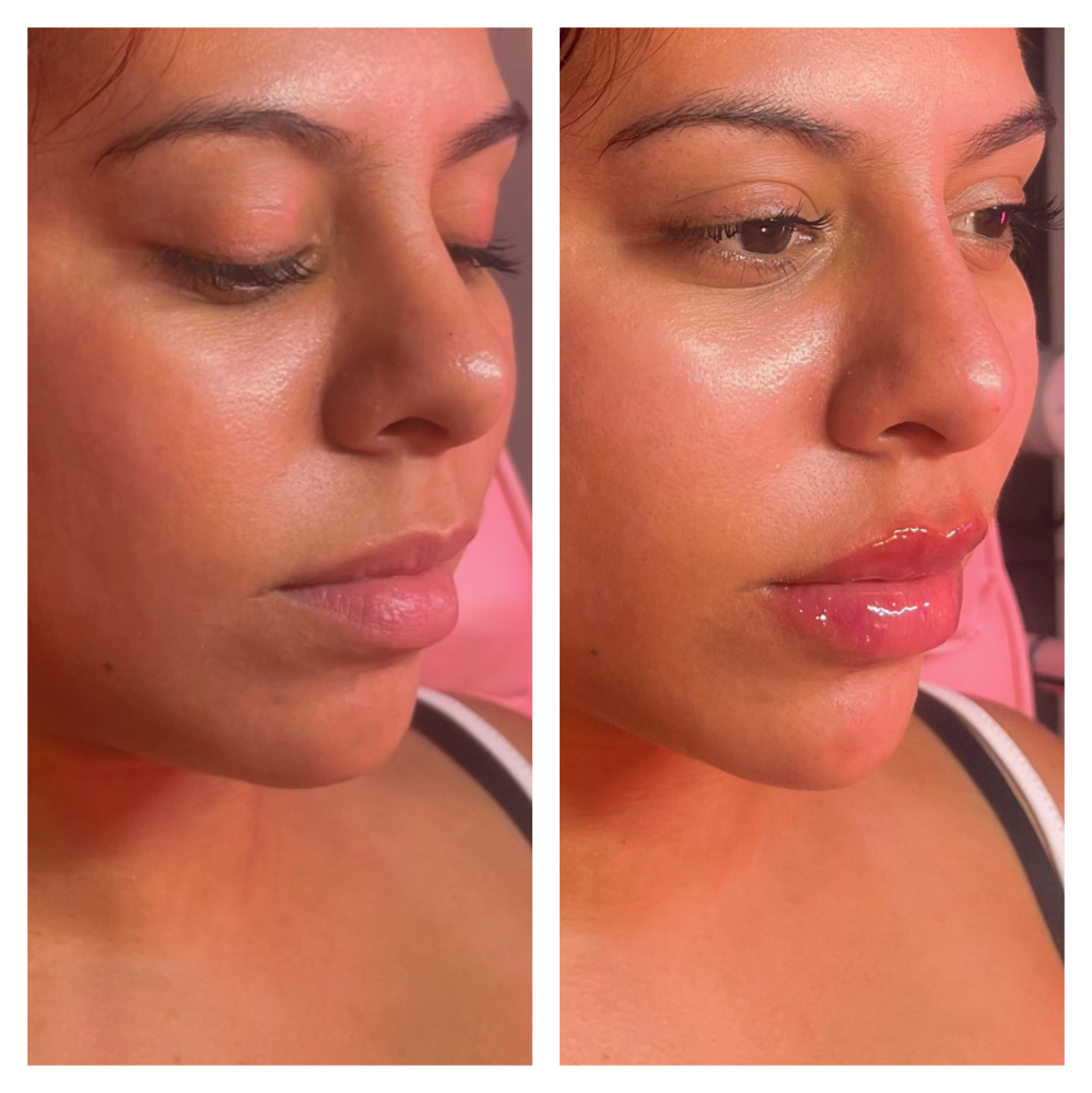 Chin Contour