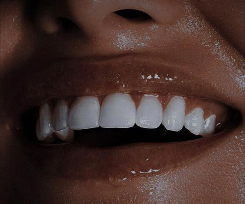 Teeth Whitening