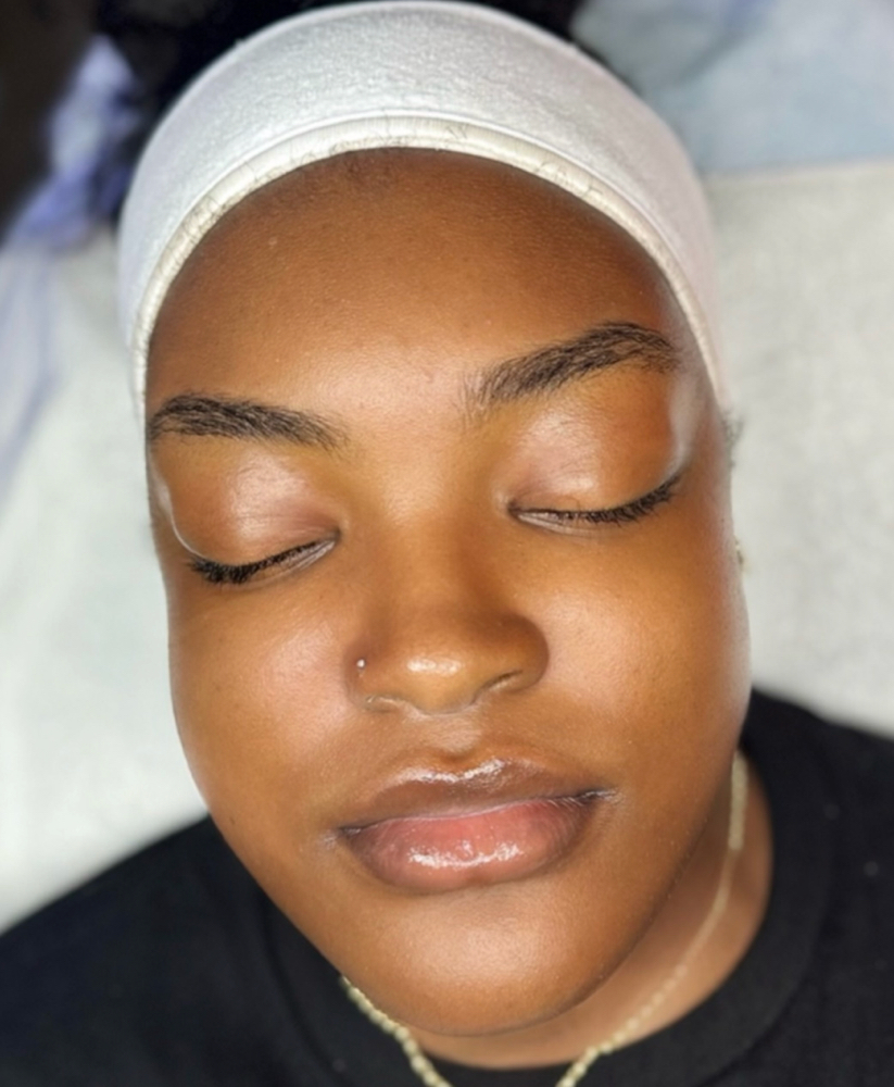 Hydradermabrasion