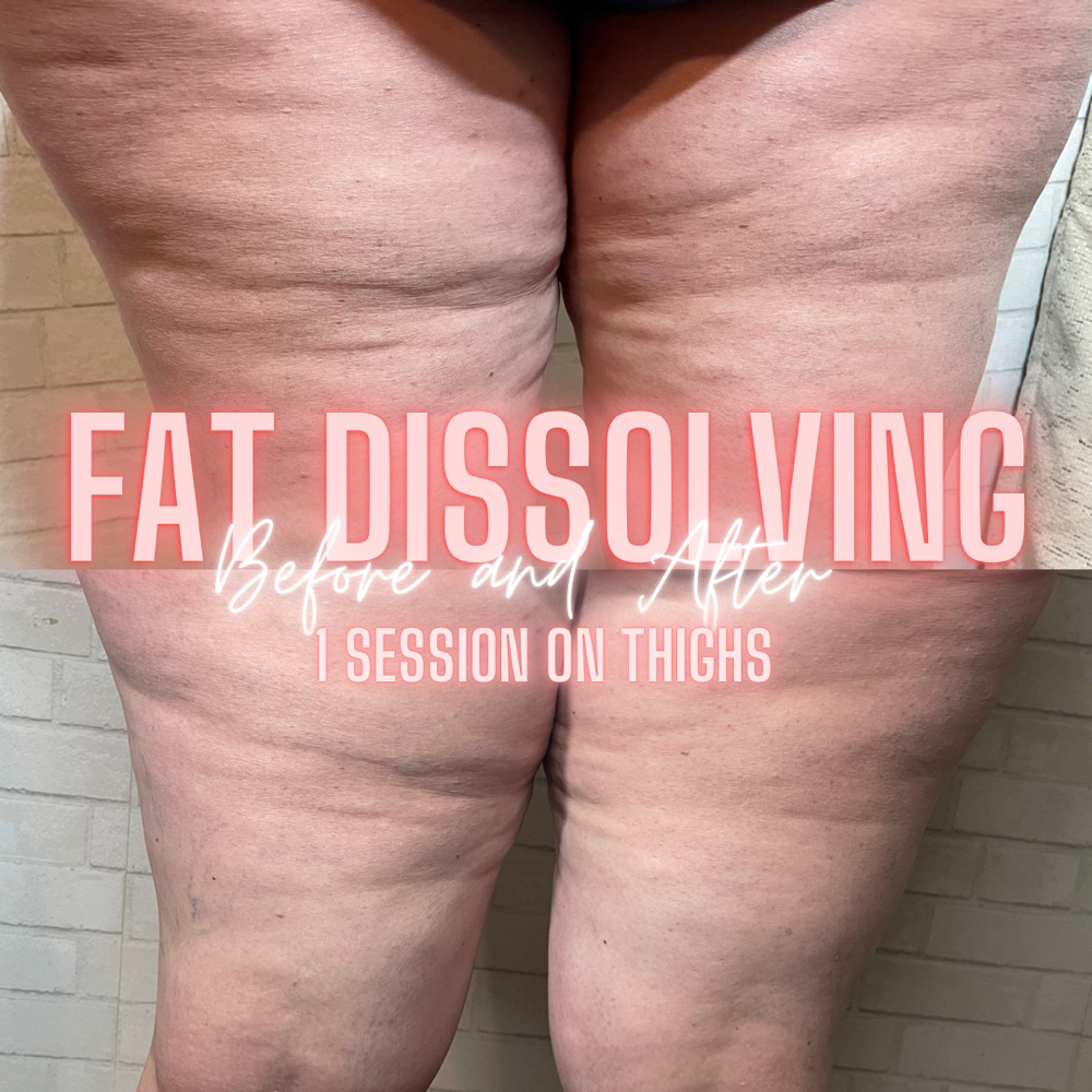 Fat Dissolving Any OTHER Body Part