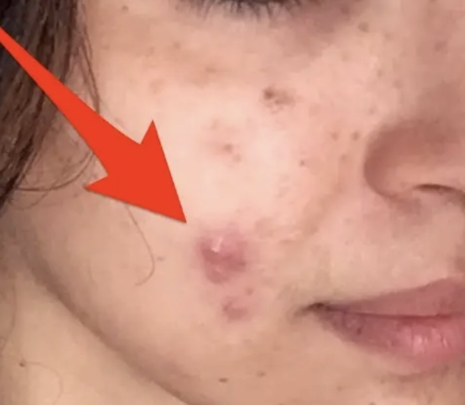 Deep Peel Spot Tx