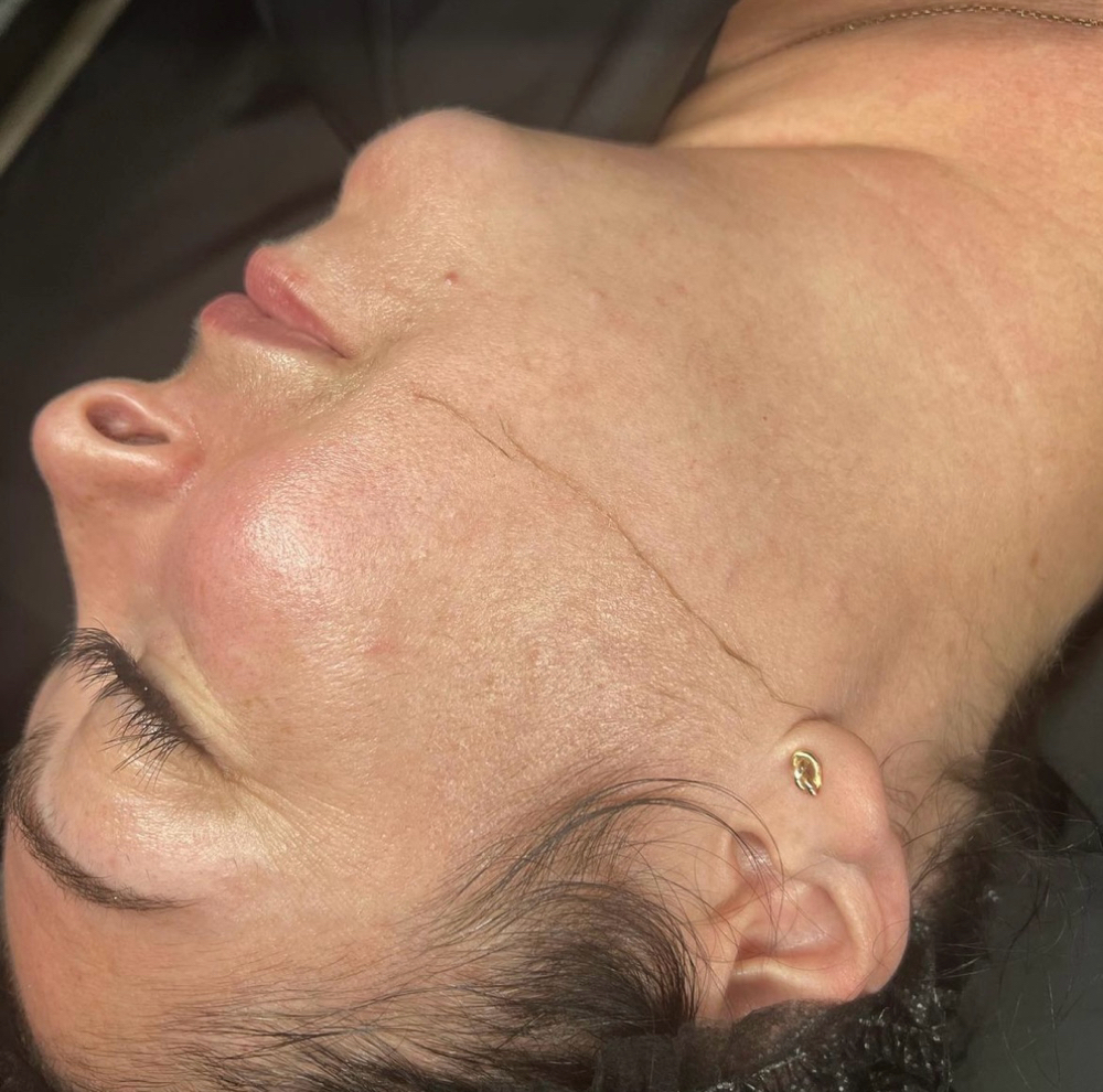 Dermaplane Facial