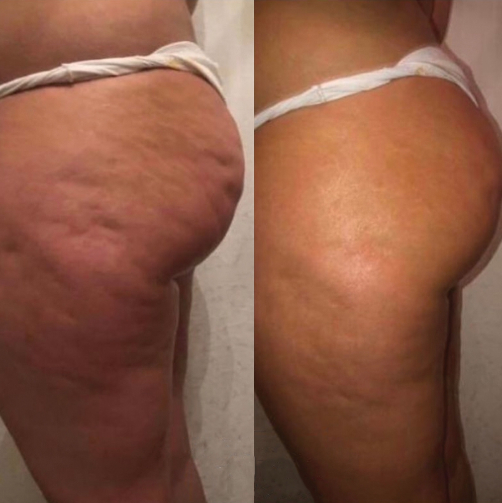 Bioslim Single Session