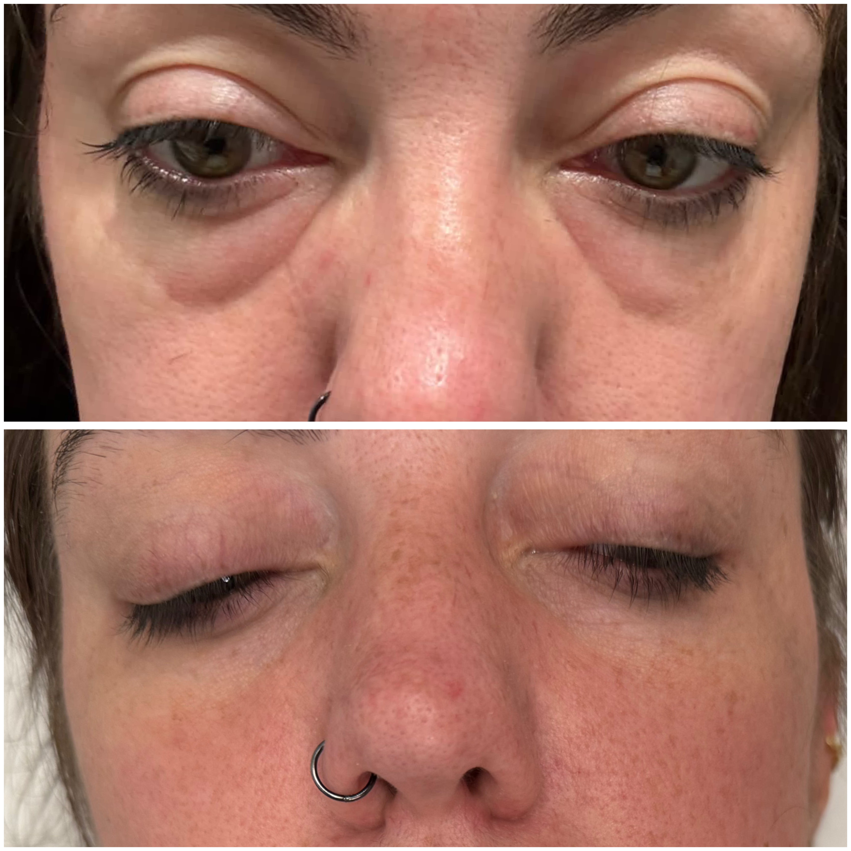Skin Boosters