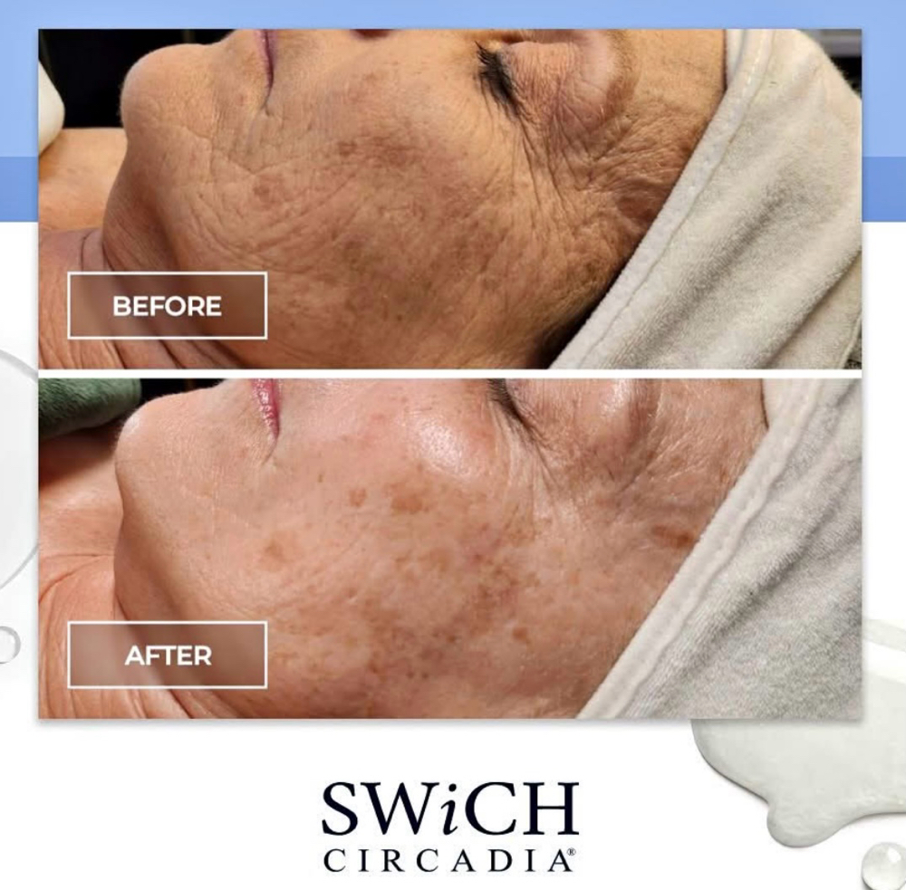 ✨SWICH Chemical PEEL Alternative