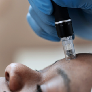 Microneedling at OD Medical Skin & Hair Sanctuary - Long Island in Rockville Centre, NY