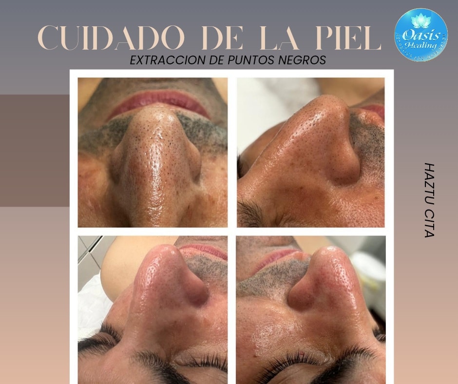 Men Facial blackhead nose and face.