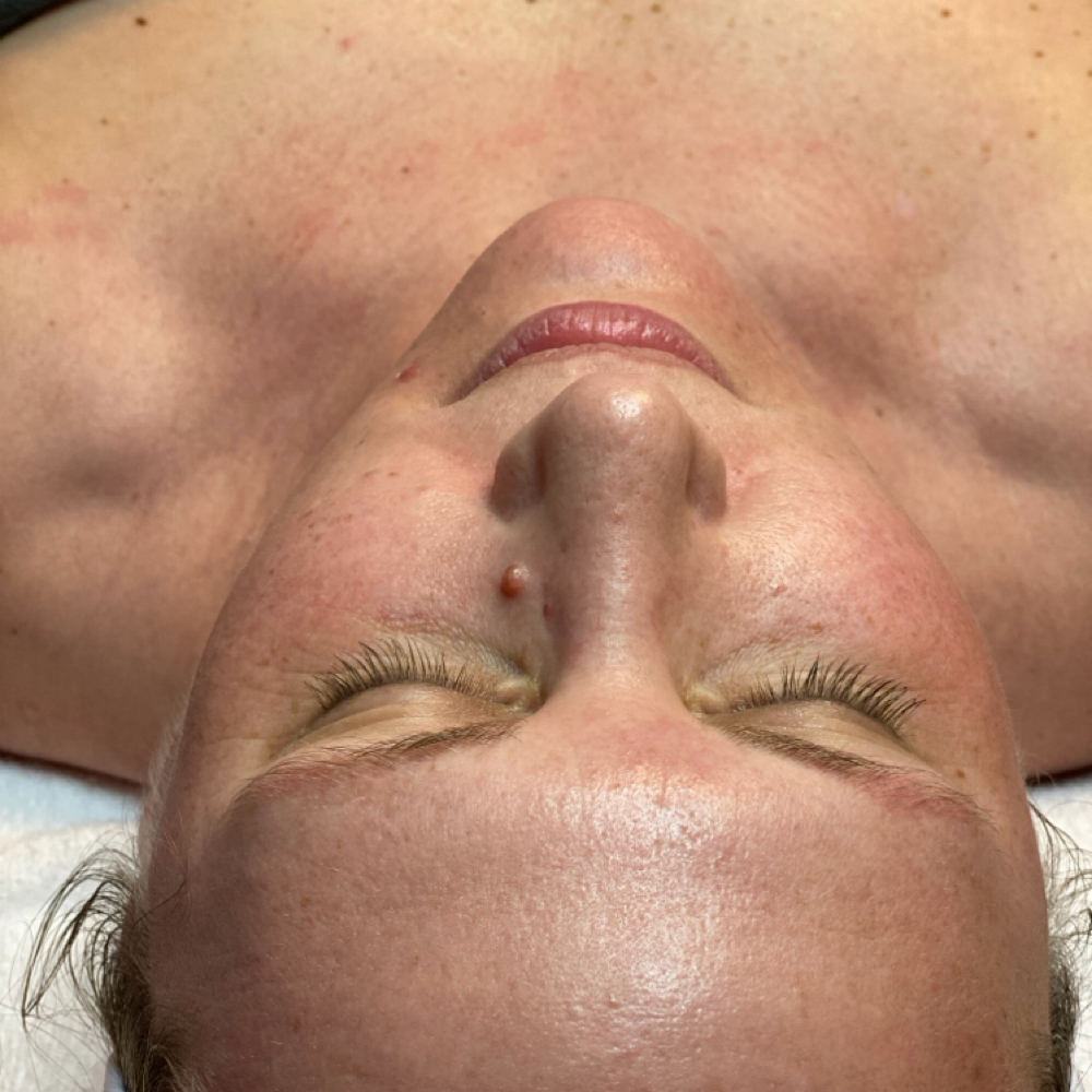 Platinum HydraFacial at Glam by Tam Aesthetics in Madison, WI