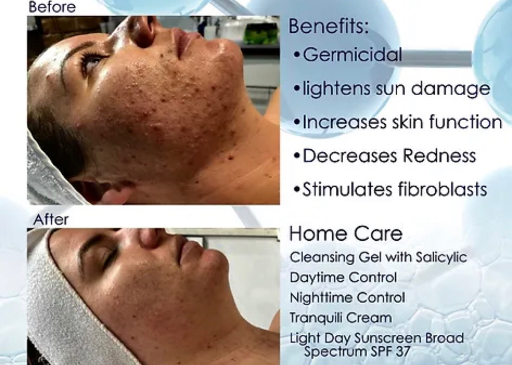 Oxygen RX Treatment