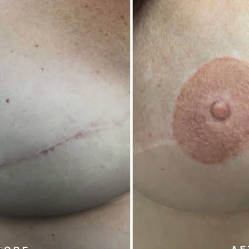 3D Areola restoration at Revive Skin by Ang in Downey, CA