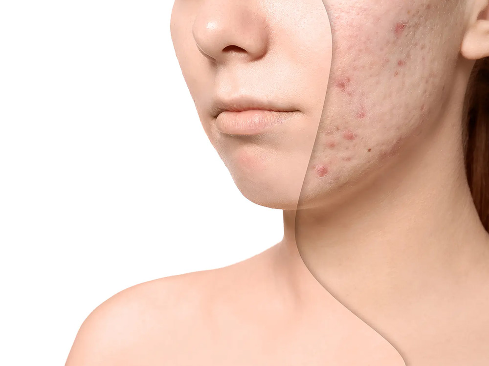 Acne Defense Facial