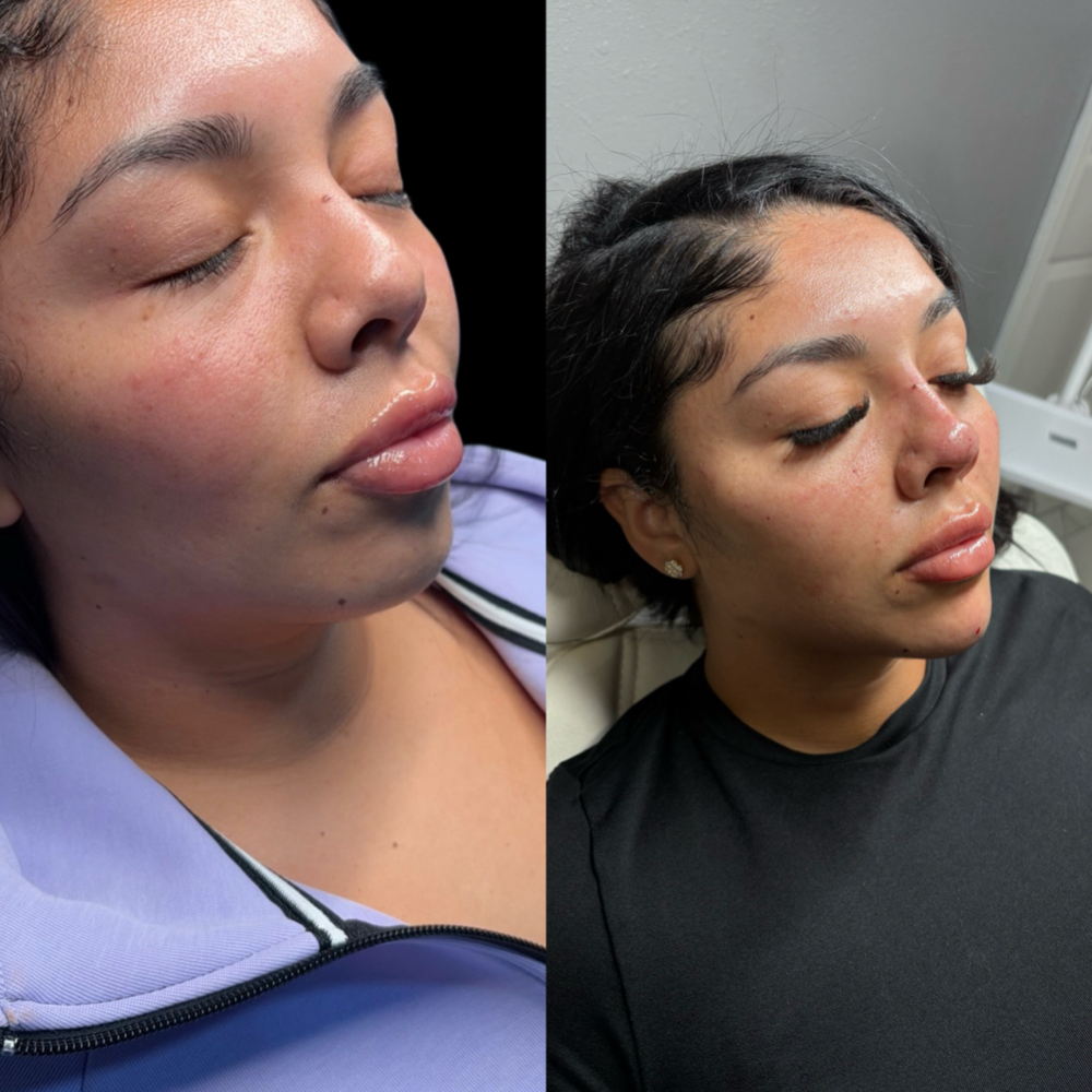 Cheek Filler at Balance.Bar.Aesthetics in Berkeley, CA