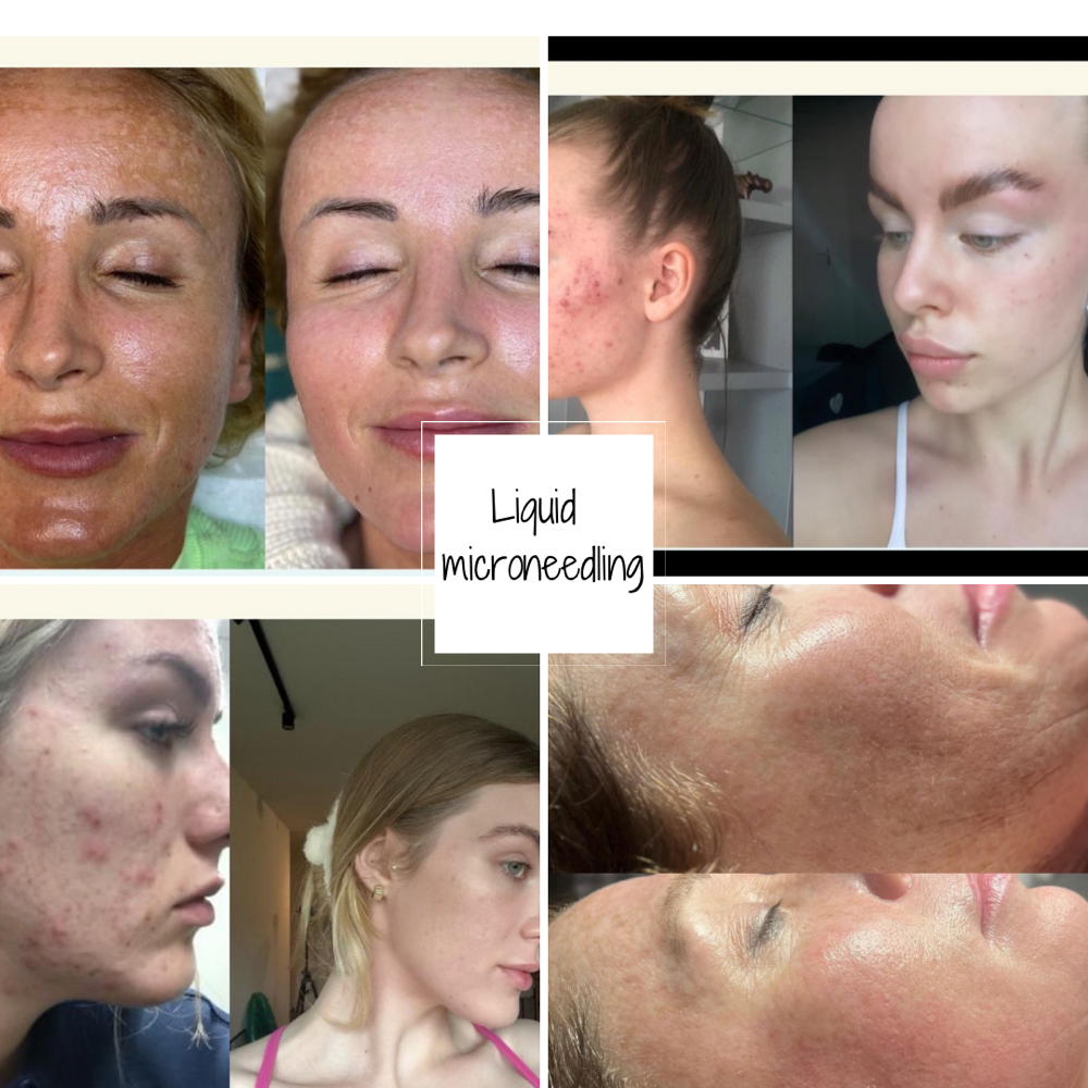 Liquid Microneedling