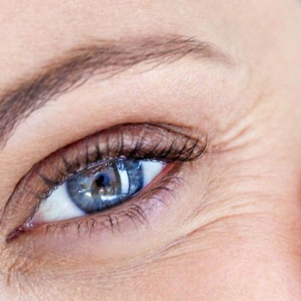 Crows Feet at Precision Aesthetics LLC in Harrodsburg, KY