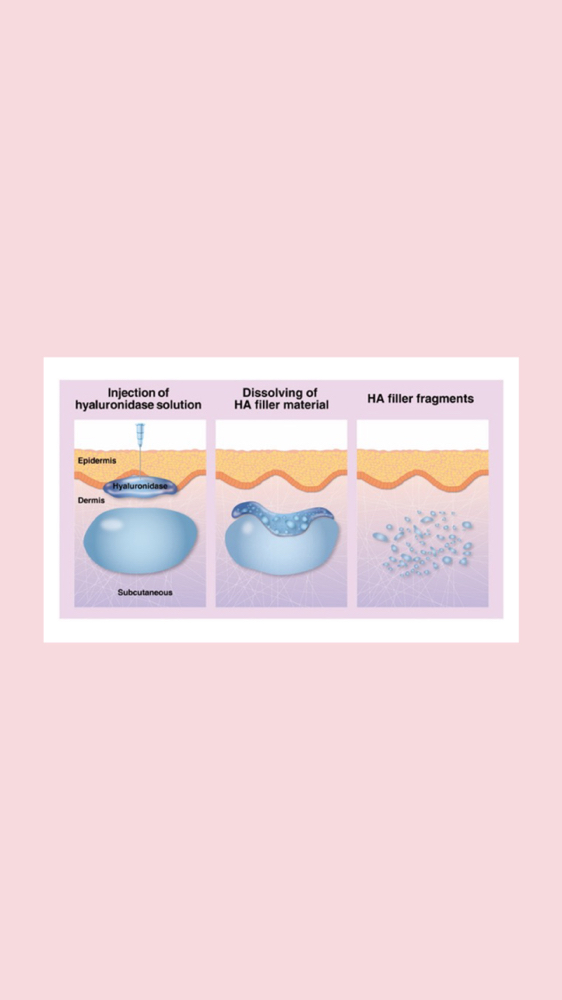 Hylenex Filler Dissolving