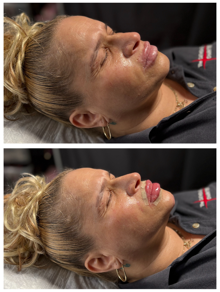 Chin Fillers 1ml