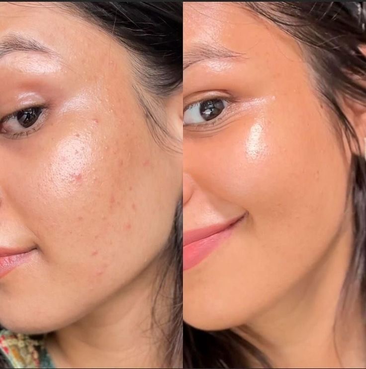 Acne Facial