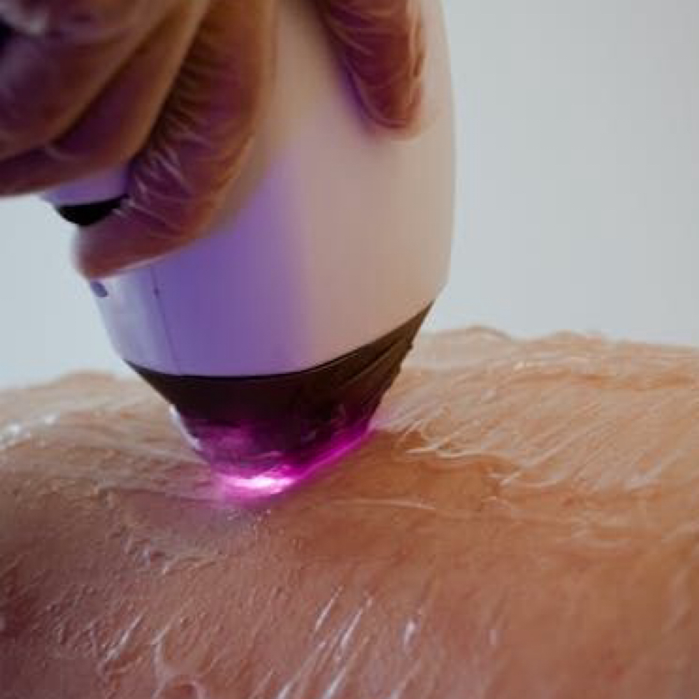 Touch Up Session at MySkin Aesthetics in Laredo, TX