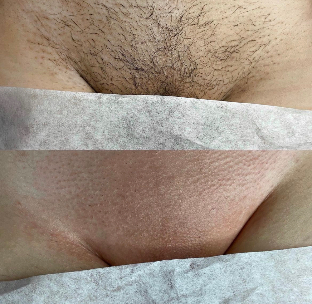Brazilian 8+ Weeks