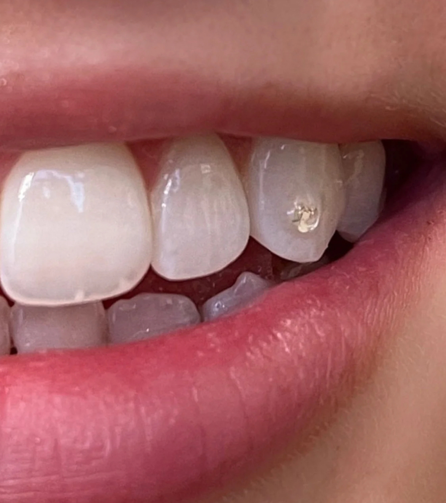 Tooth Gem Application- Show Stopper