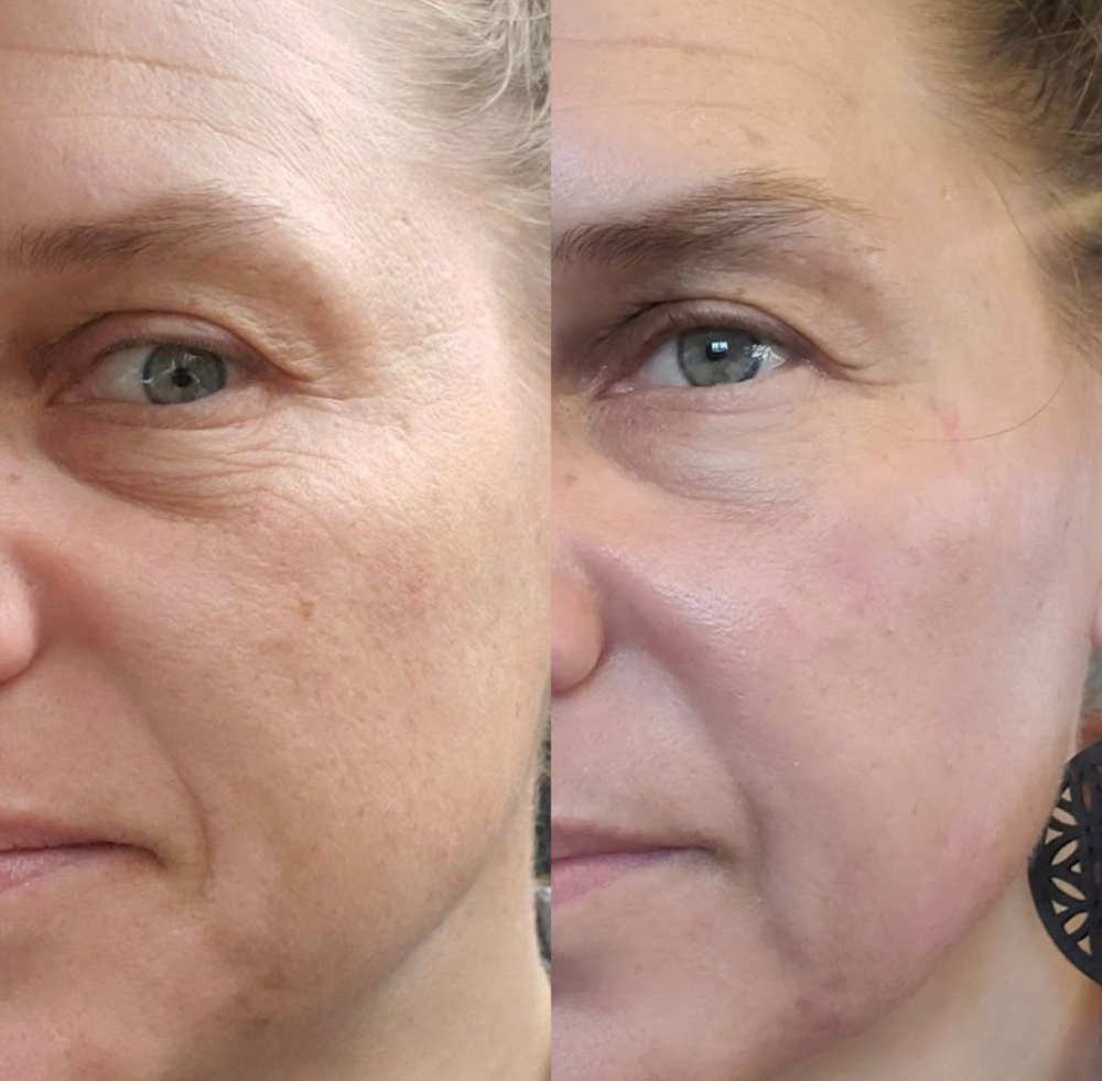 Erbium Peel, Face Laser Treatment