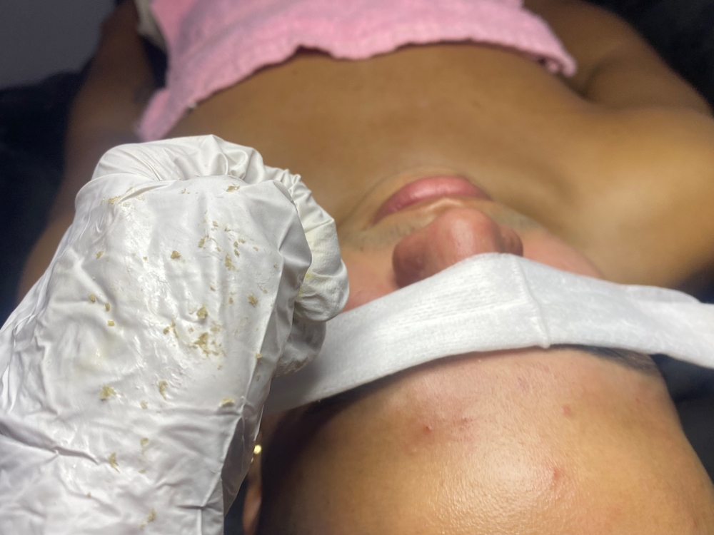 Facial Tx Acné