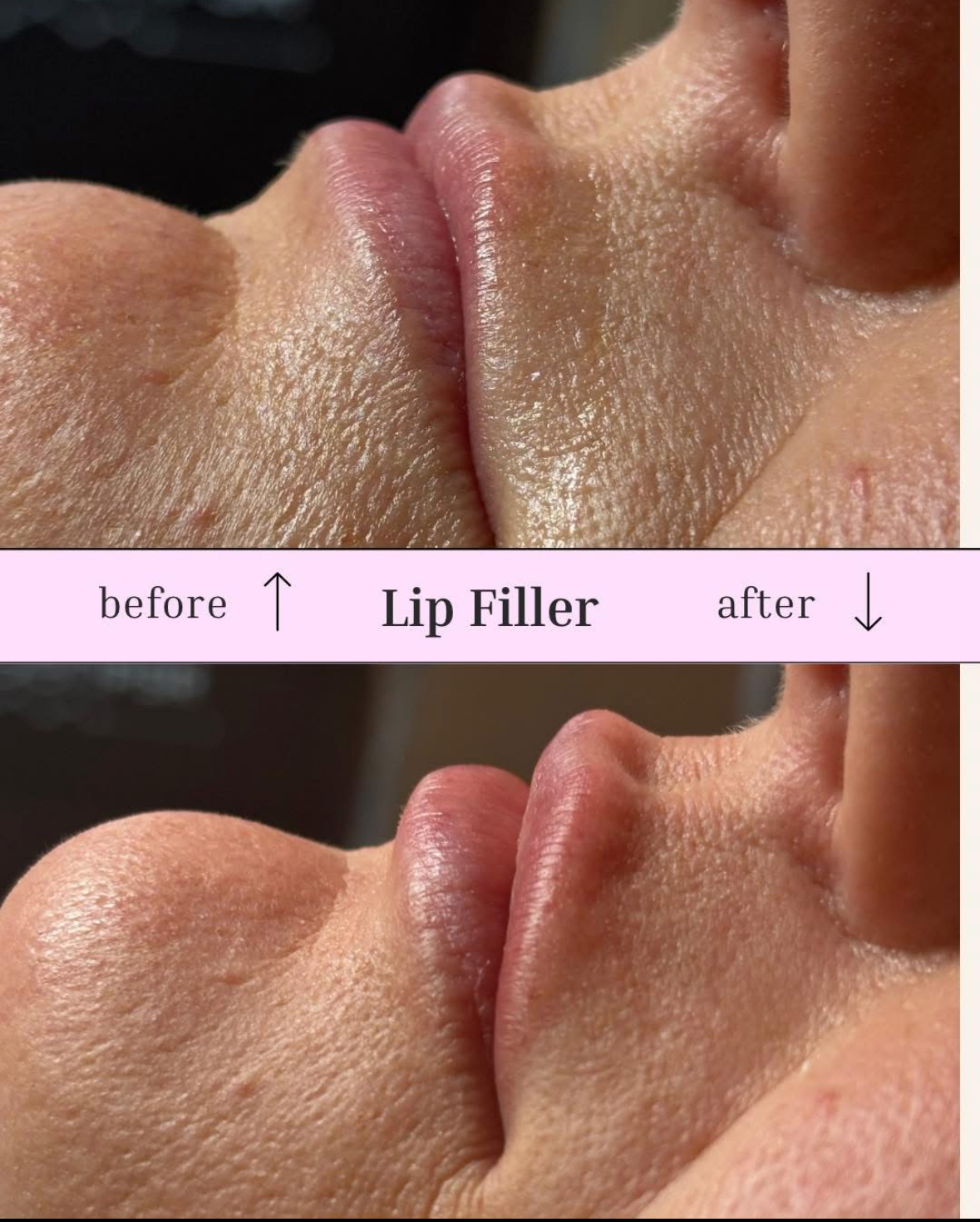 Lip Filler