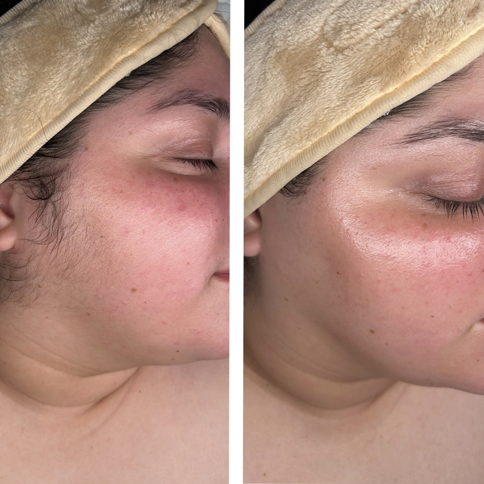 Dermaplaning
