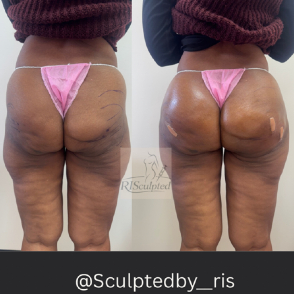 The “Bratz” Doll (500ml) at RISculpted Aesthetics in Stockbridge, GA