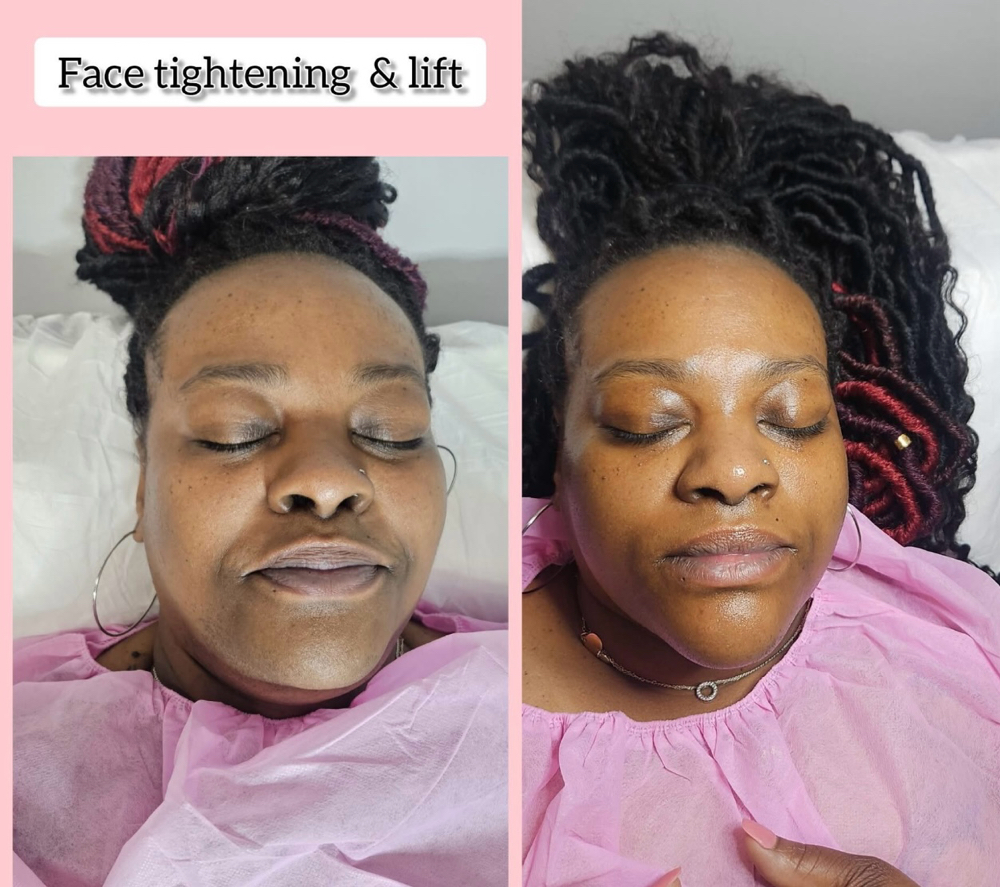 Laser Chin & Face Lift Treatment