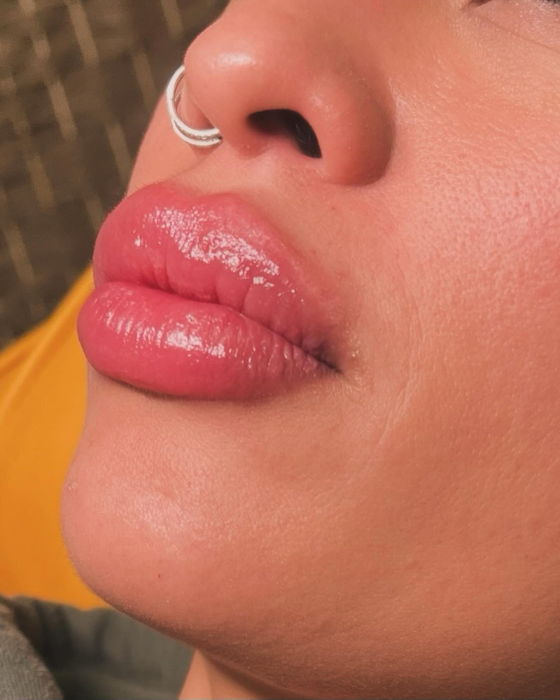 Mini Plump With Revanesse