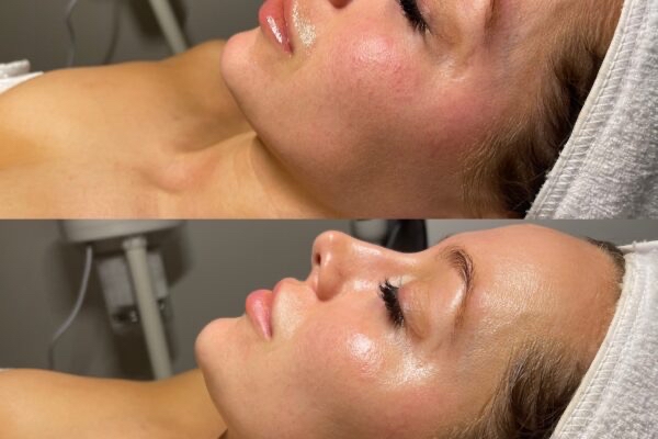 Aqua Jet Peel W/ Dermaplane