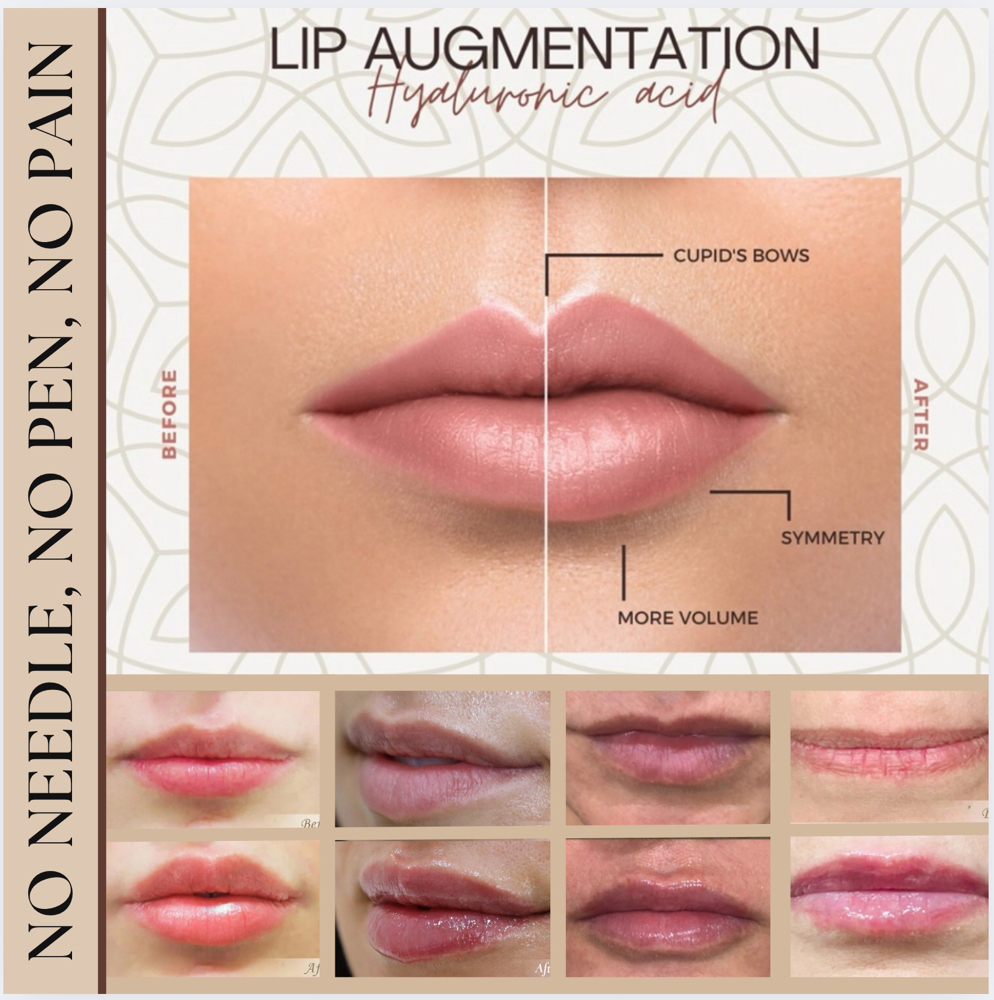 3 Meso Lip-Licious  (NO NEEDLE)