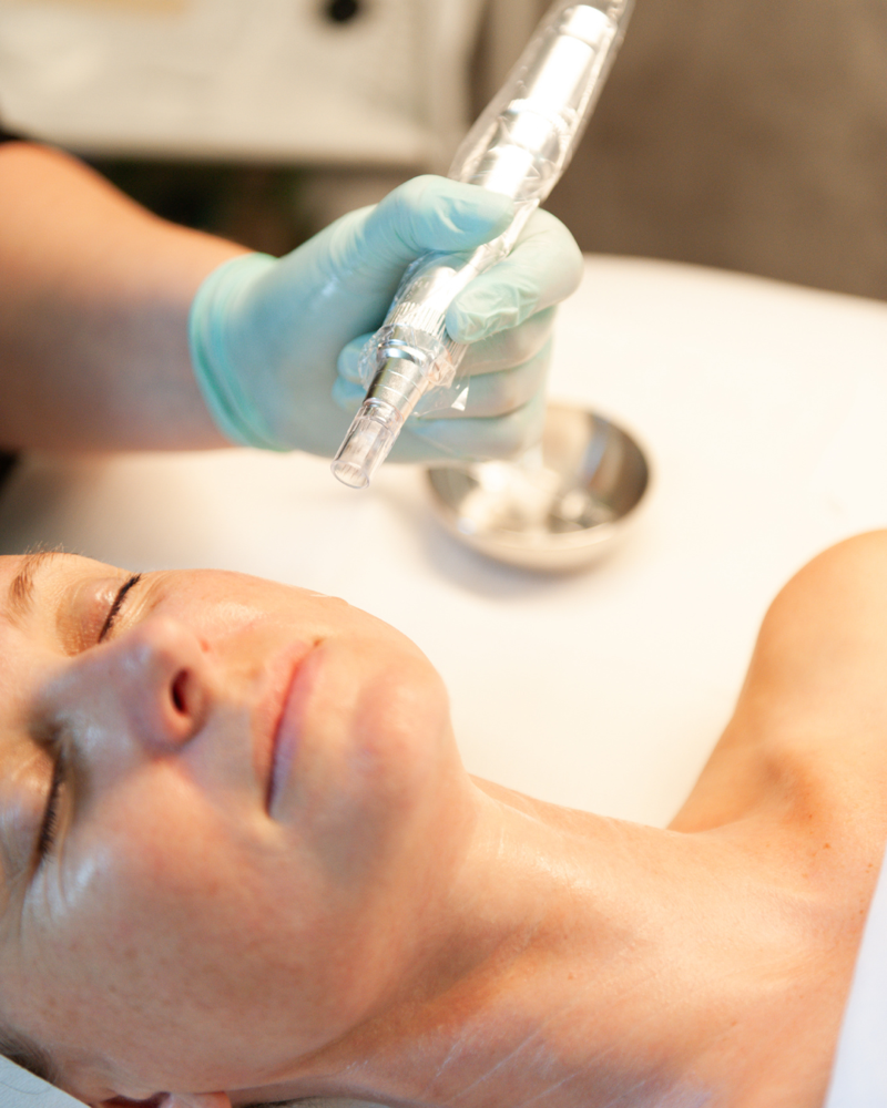 Microneedling+ Treatment- Face