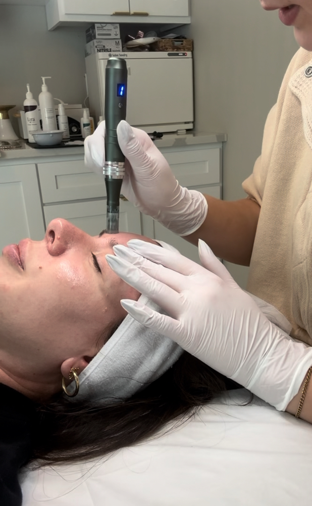 Microneedling