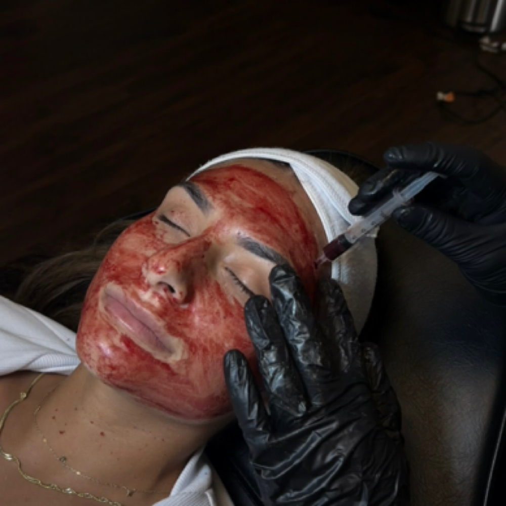PRP Microneedling at Haus of Hands Body Bar in Gahanna, OH