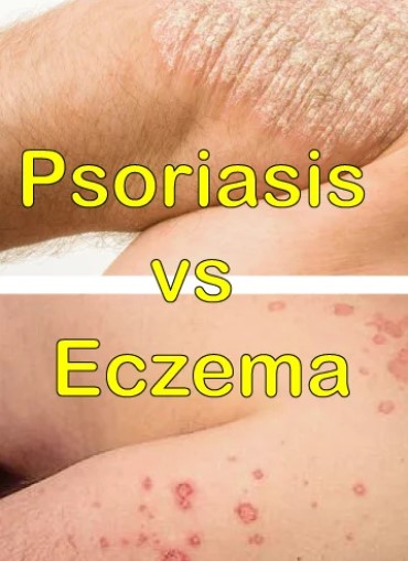 Psoriasis/Eczema Prone Session