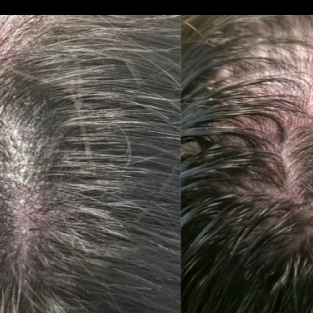 Psoriasis/Eczema Prone Session at The Hidden Trough Aesthetics in Aiken, SC