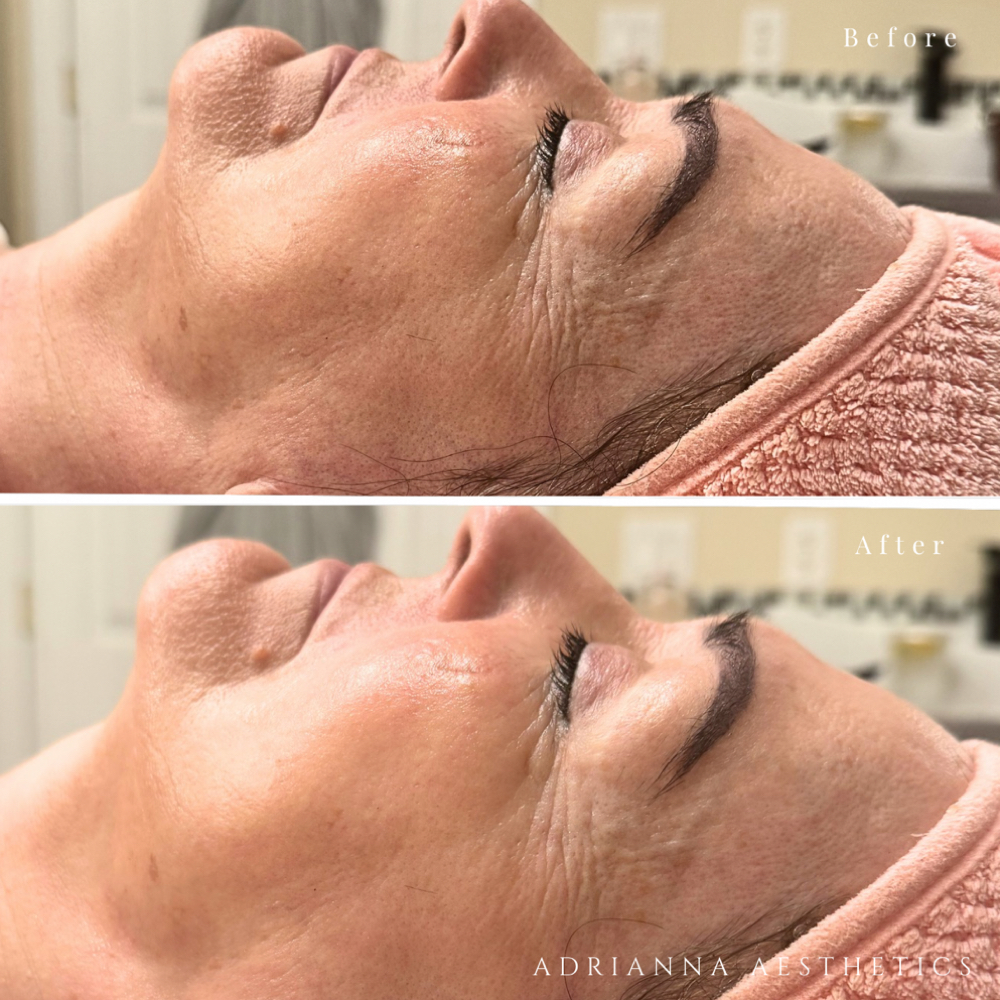 Firming Peptide Treatment ⭐️ at Adrianna Aesthetics in Winston Salem, NC