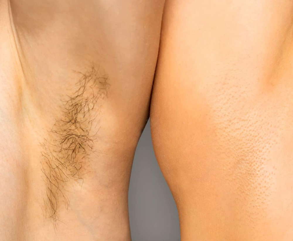 Underarm at Sunshine Beauty Salon in Corning, CA