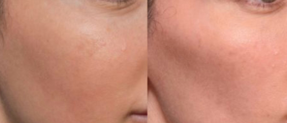 Restylane Lyft Cheek Augmentation