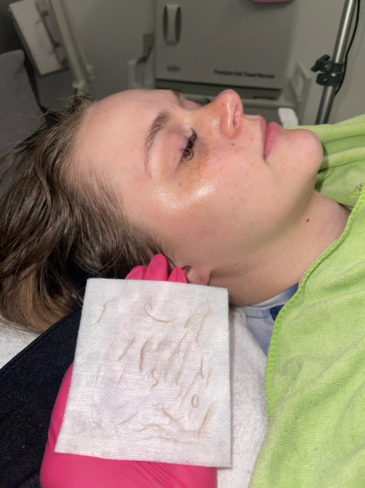 Dermaplane Facial