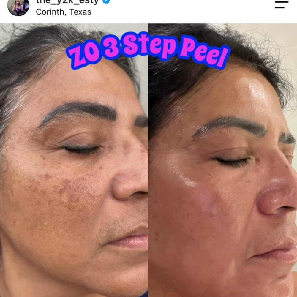 ZO 3-Step Peel at Alchemy Skin in Lewisville, TX