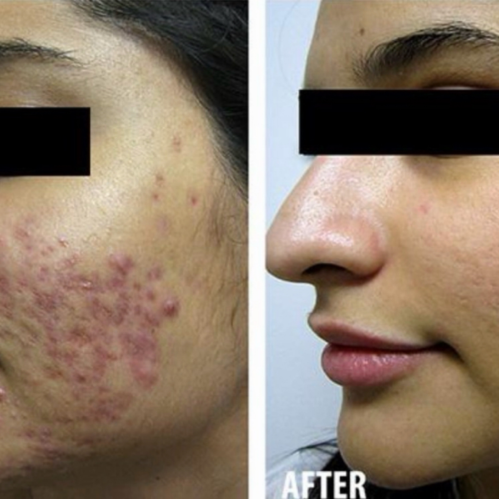 The Refined Resurfacing at Redeemed Radiance Aesthetics & Cosmetic Injections in San Antonio, TX