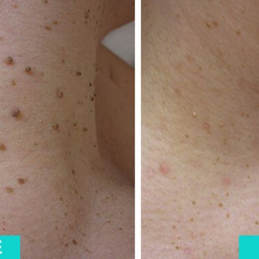 Skin Tag Removal at SR Beauty Studios in Sacramento, CA