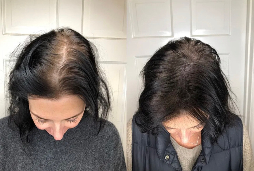 Scalp Microblading