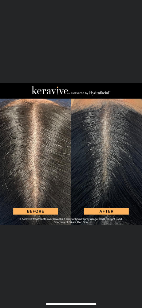 Keravive Partial Scalp