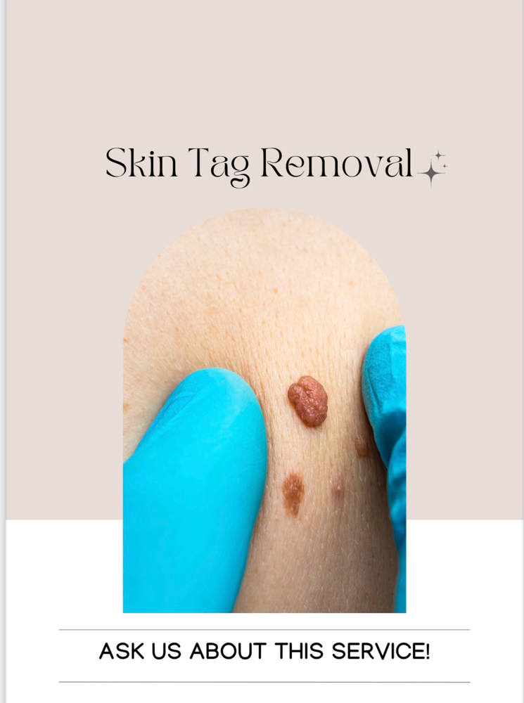 Skin Tag Removal