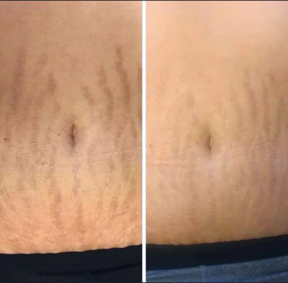 Stretch Mark Camouflauge